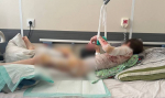 20 наркозов и две пересадки кожи: в Благовещенске мальчик получил страшные ожоги из-за «детской шалости»